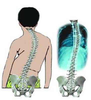 强直性脊柱炎的身体会出现哪些症状