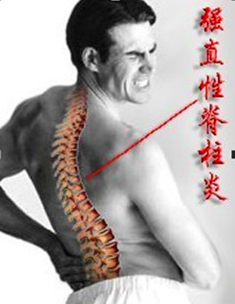 强直性脊柱炎的发病表现